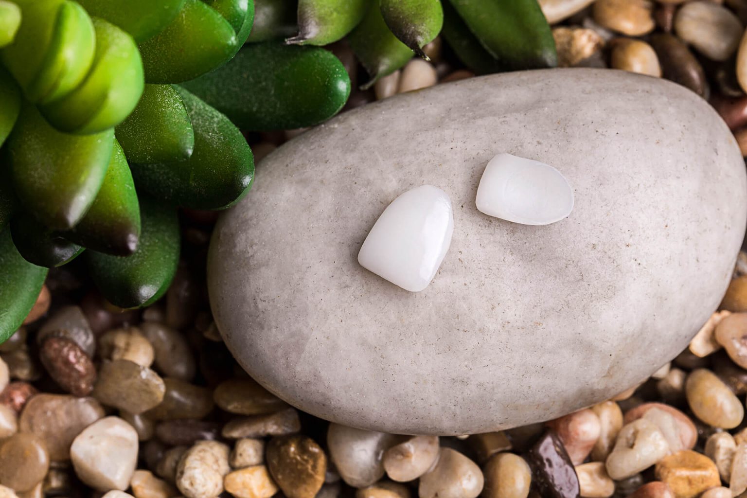 Veneers Dental Laser Nogales